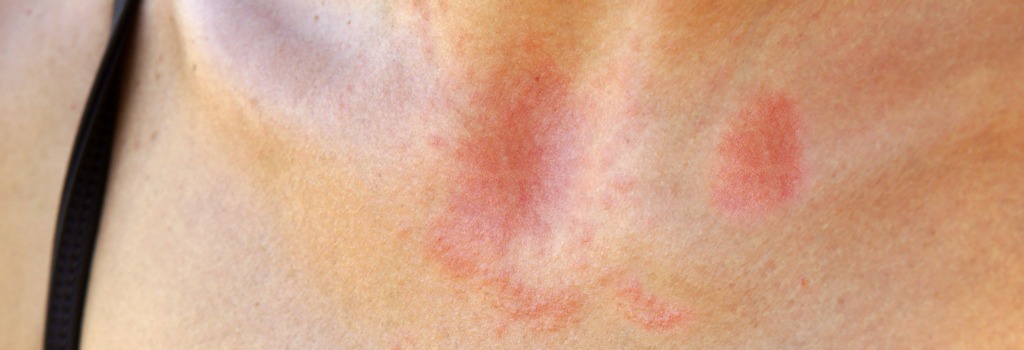 Nebenwirkungen der Bestrahlung