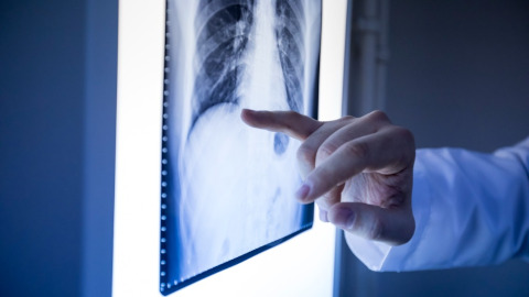 Nebenwirkungen von Knochenmetastasen