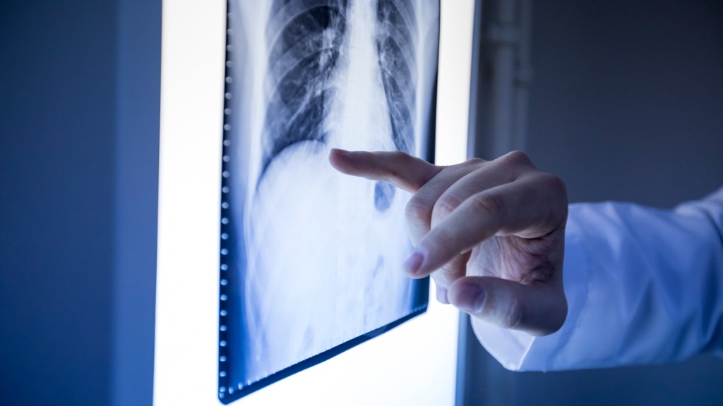 Knochenmetastasen bei einer Krebserkrankung! Absiedelung von Krebszellen.