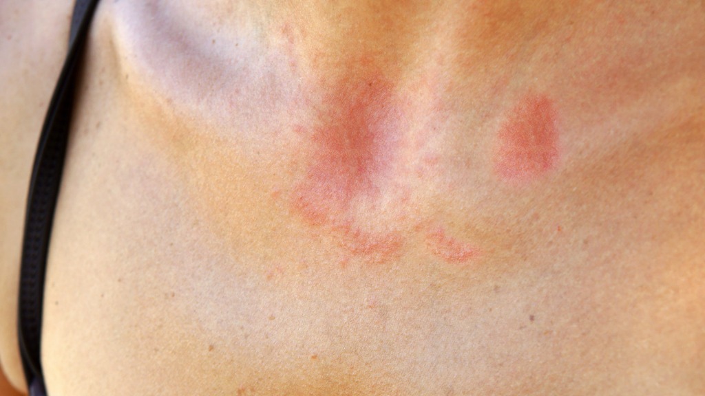 Nebenwirkungen der Bestrahlung bei Krebs