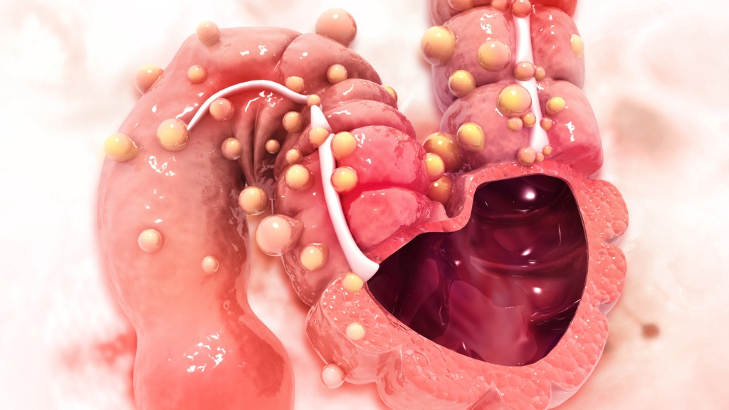 Risikofaktoren von Darmkrebs (kolorektales Karzinom)