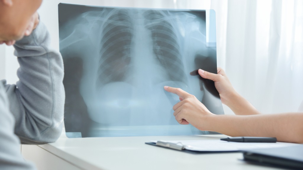 Früherkennung Lungenkrebs (Bronchialkarzinom)