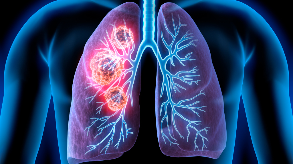 Was ist Lungenkrebs? Wo entsteht der Tumor im Lunge? Was ist Lungenkrebs? Wo entsteht der Tumor im Lunge?