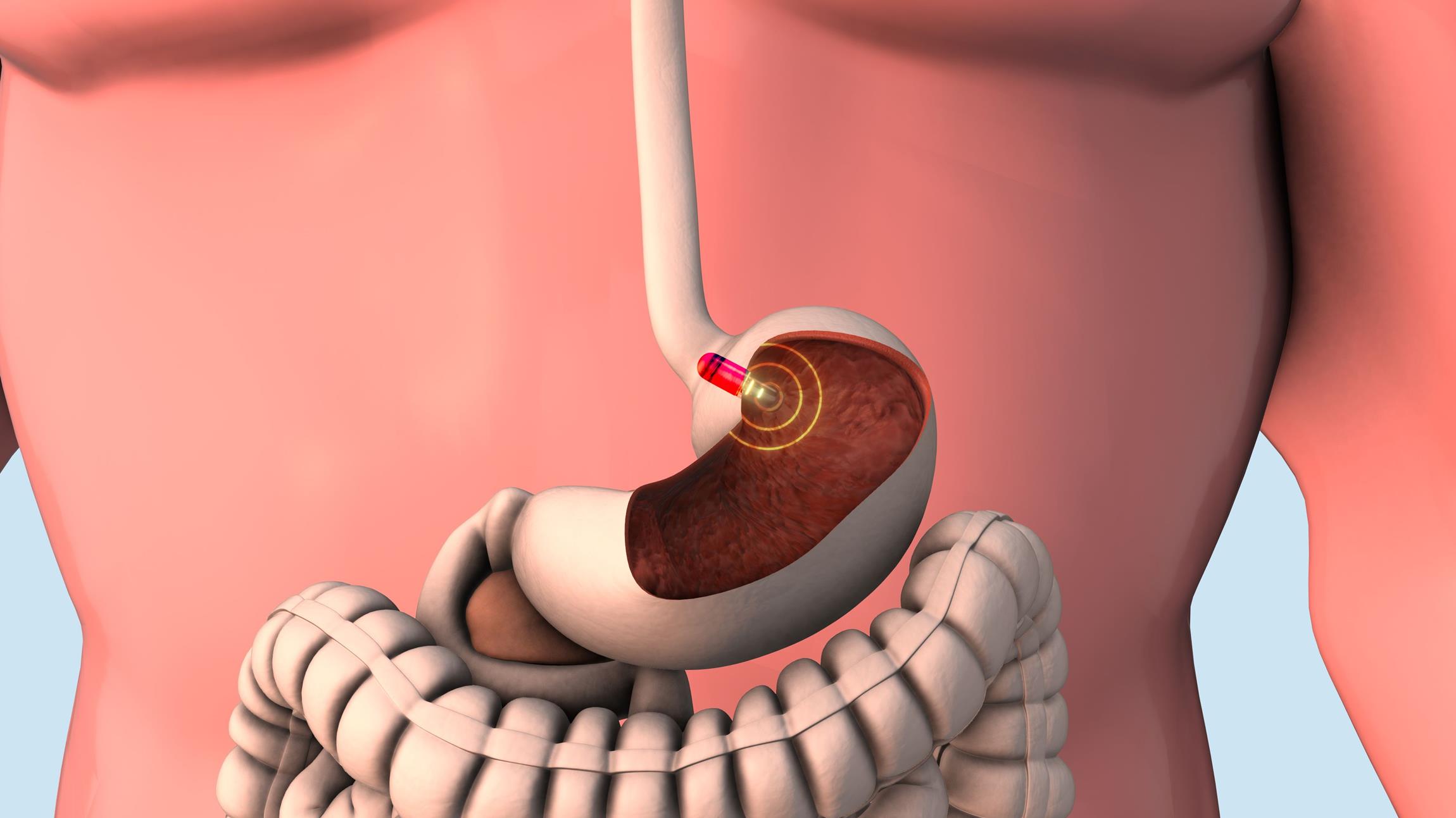 Endoskopiekapsel im Magen