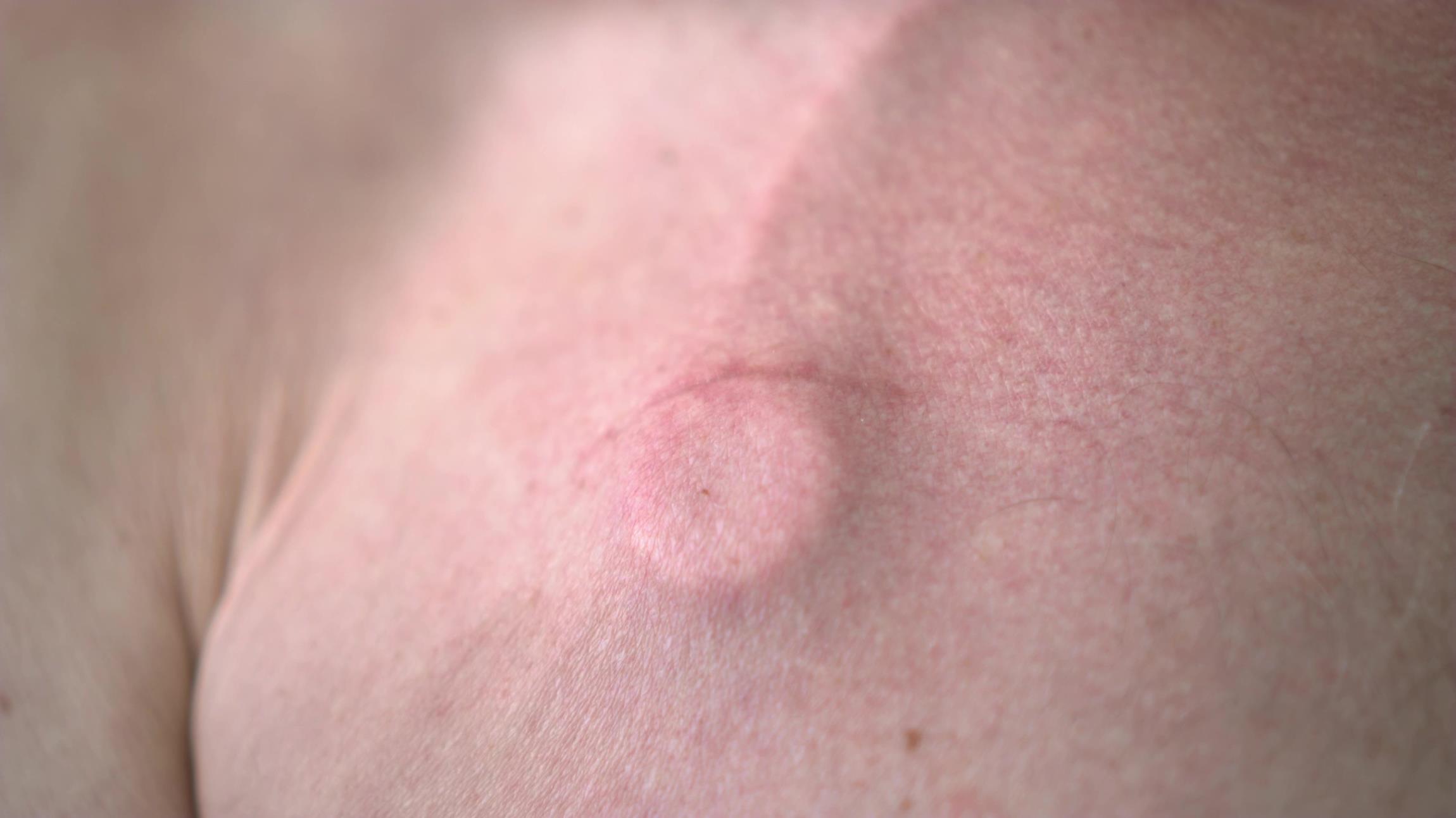 Nahaufnahme Mann mit Port Katheter