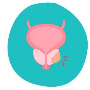 Icon Prostatakarzinom