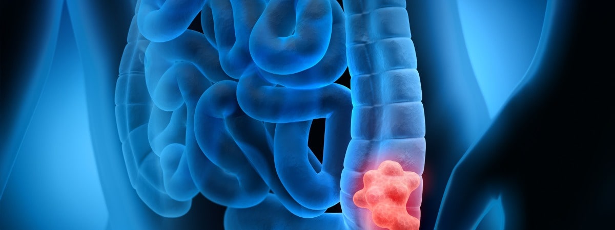 Darmkrebs: Krebserkrankungen des Dickdarms Kolonkarzinom.