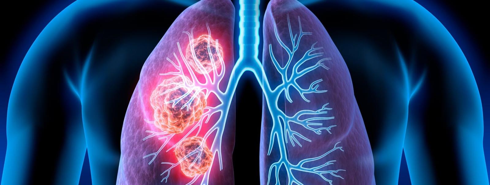  Lungenkrebs - Lungen/-Bronchialkarzinom: Eine der häufigsten bösartigen Krebserkrankungen