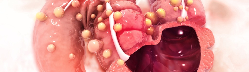 Risikofaktoren und Ursachen von Darmkrebs