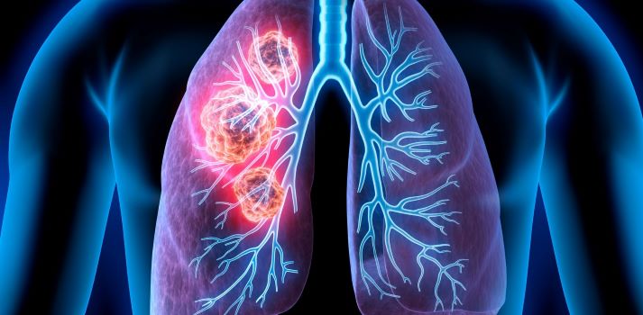 Was ist Lungenkrebs? Wo entsteht der Tumor im Lunge?