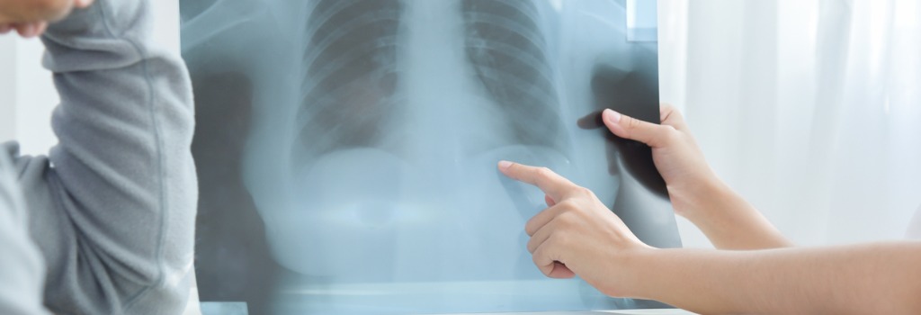 Früherkennung Lungenkrebs (Bronchialkarzinom)